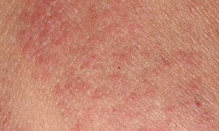 Moderate Eczema on Skin