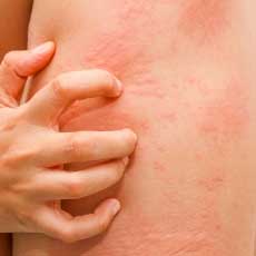 Hives Rash on Skin - Can Quercetin Help?