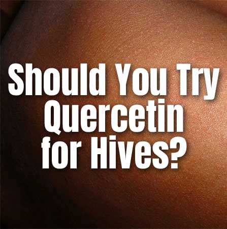 Should You Try Quercetin for Hives? (Natural Anti-Histamine Found in Foods)