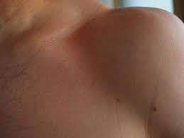 Skin Redness and Healing